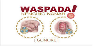 Pengobatan gonore di bekasi