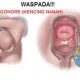 gejala gonore atau kencing nanah