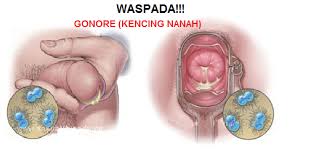 gejala gonore atau kencing nanah