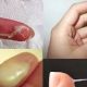 cara menyembuhkan keputihan klinikraphael.com