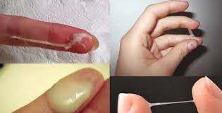 cara menyembuhkan keputihan klinikraphael.com