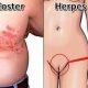 pengobatan herpes simplex bekasi