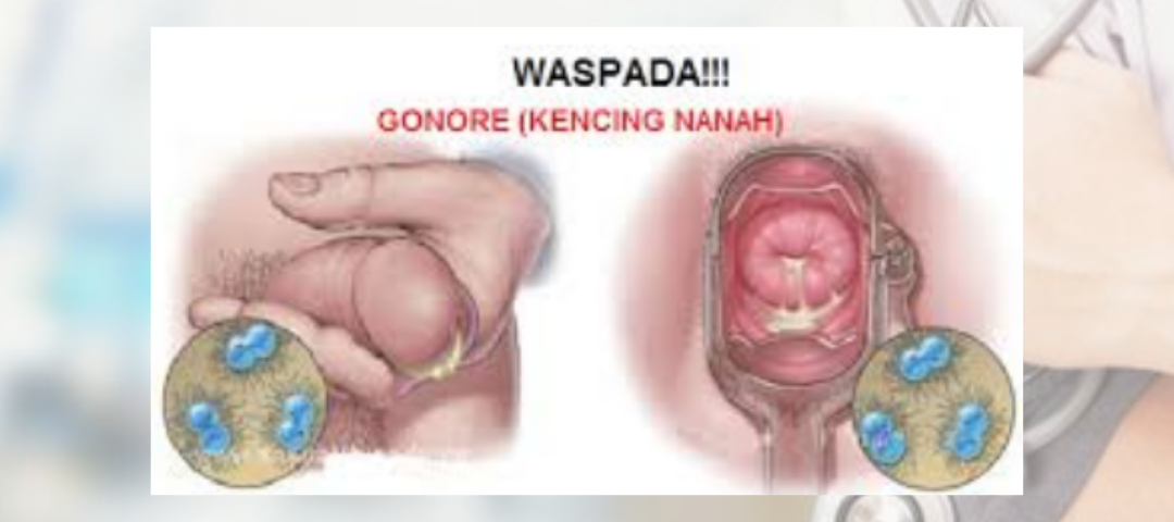 gejala gonore pada pria