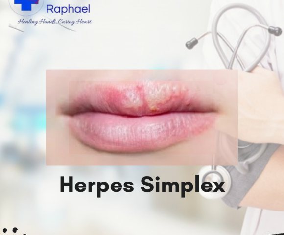 herpes