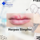 herpes