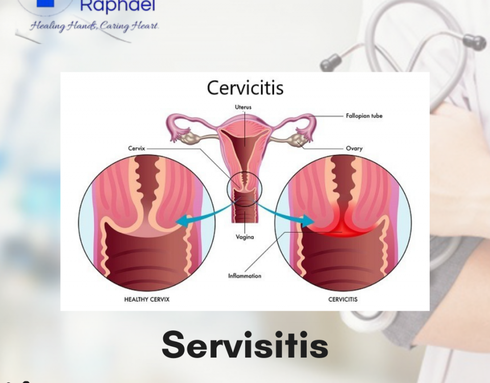 servisitis