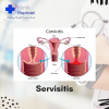 servisitis