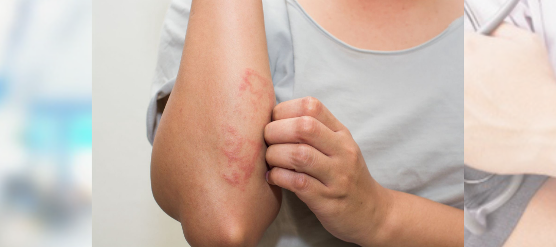 tinea cruris