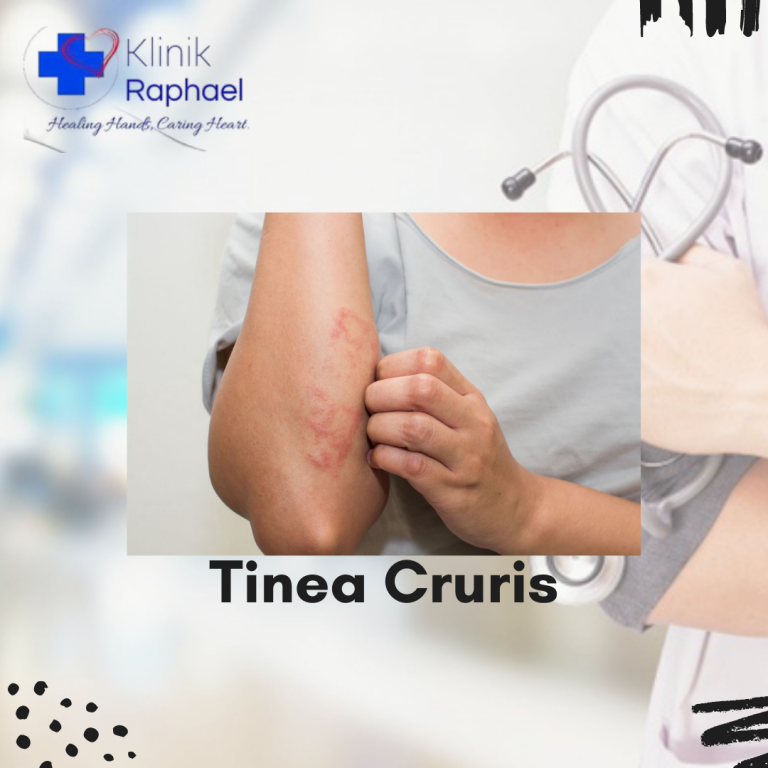tinea cruris