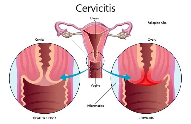 servisitis