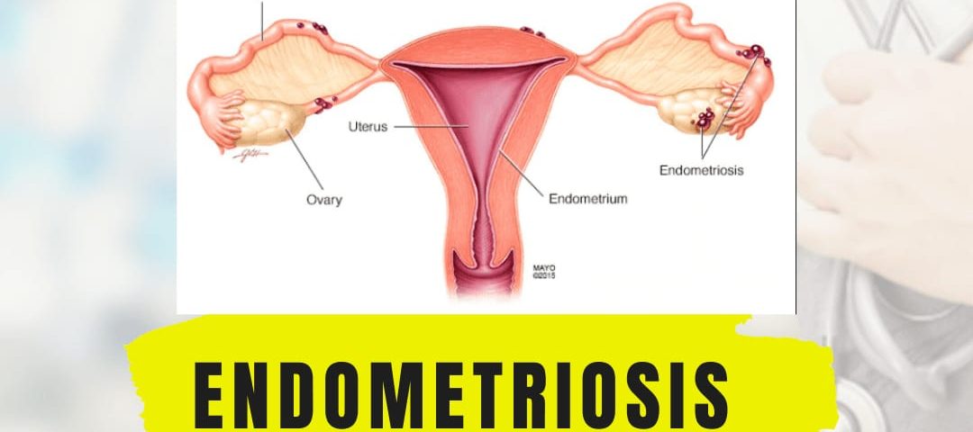 endometriosis