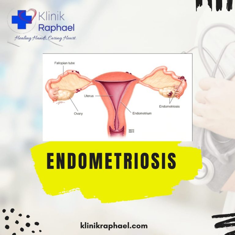 endometriosis