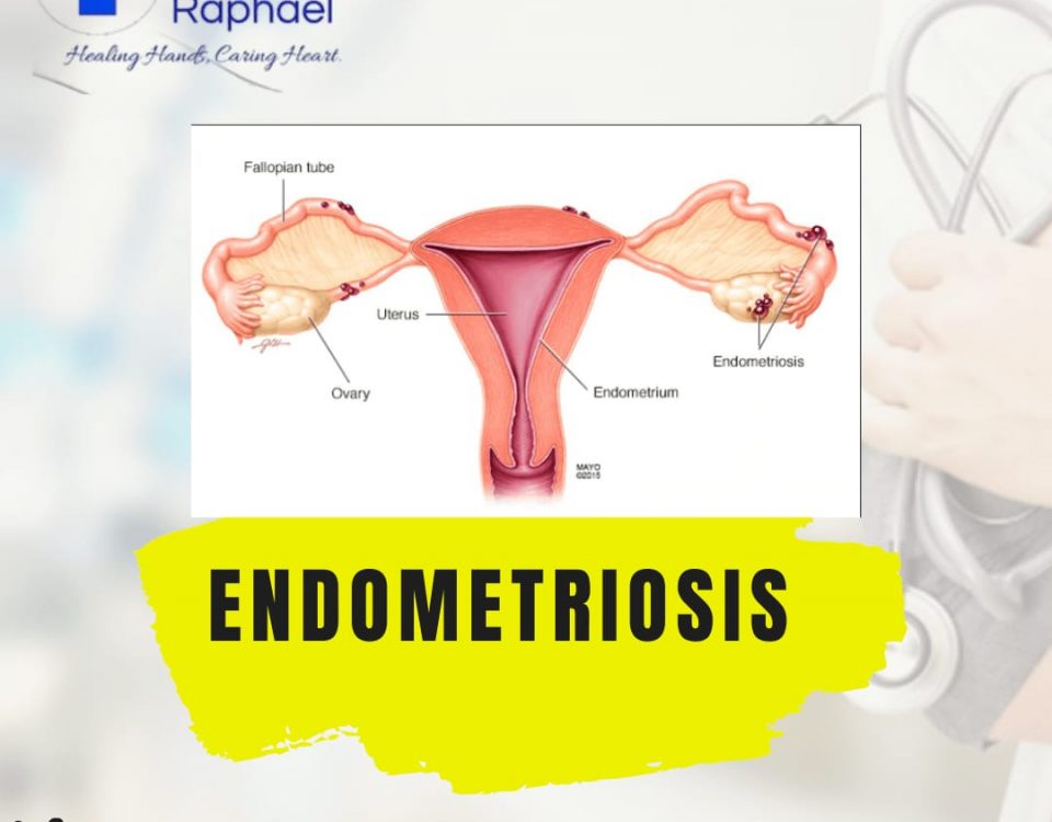 endometriosis