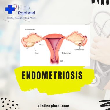 endometriosis
