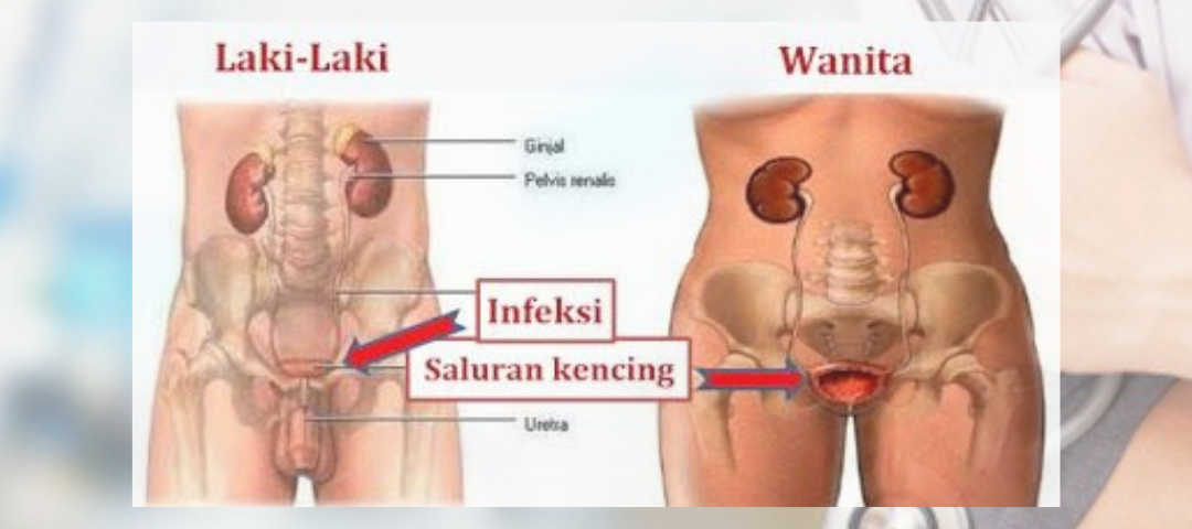Infeksi-Saluran-Kemih