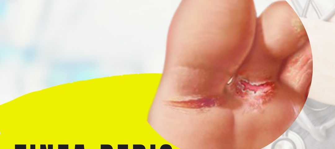 Tinea-Pedis