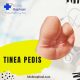 Tinea-Pedis