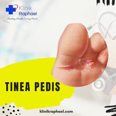 Tinea-Pedis