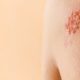 penyakit-herpes-zoster-disebabkan-oleh