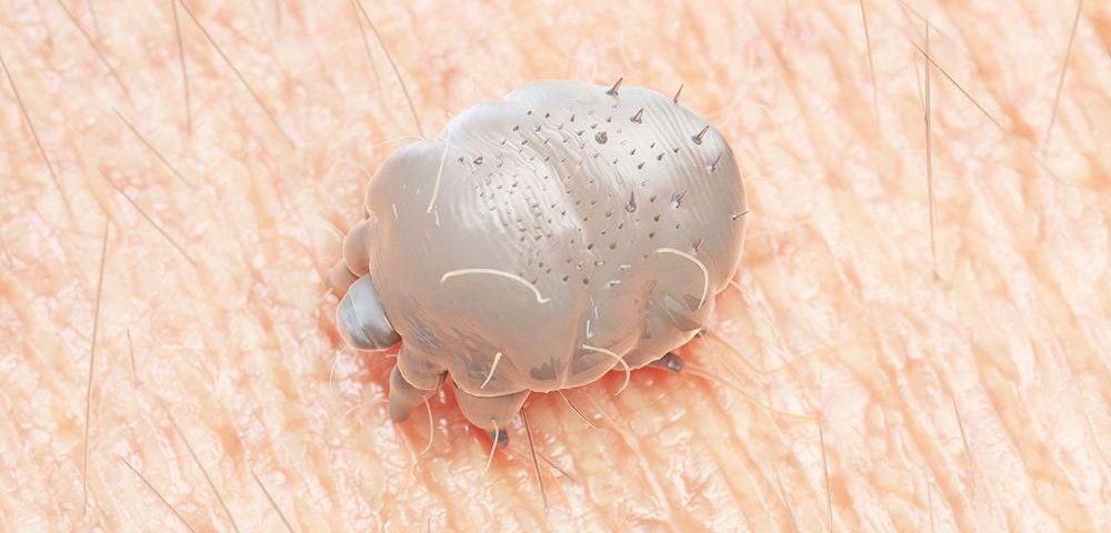cara-menghilangkan-gatal-kudis-atau-scabies