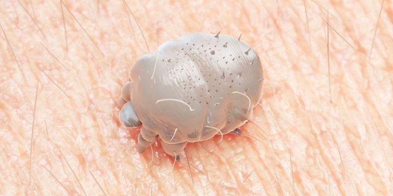 cara-menghilangkan-gatal-kudis-atau-scabies