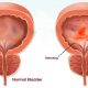 cystitis-atau-infeksi-saluran-kemih