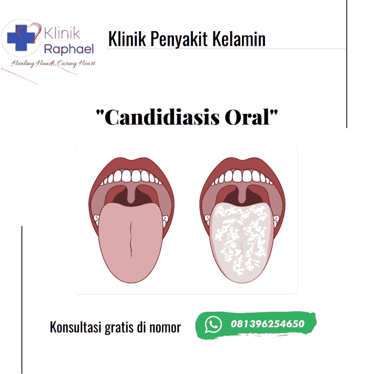 pengobatan-andidiasis-oral