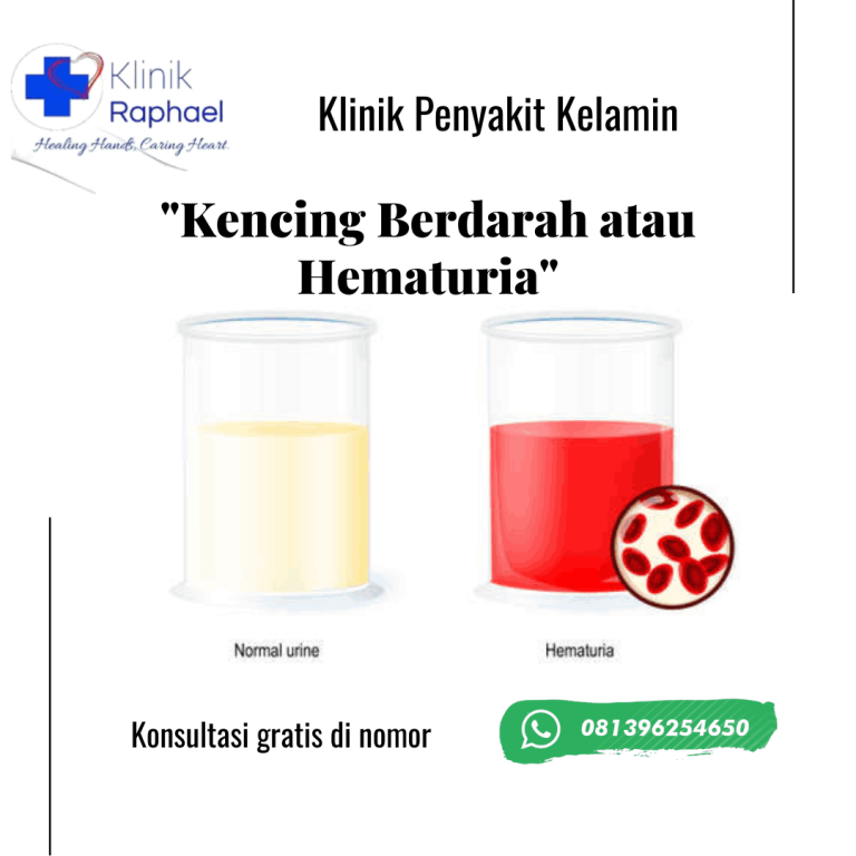 hematuria-atau-air-kencing-keluar-darah