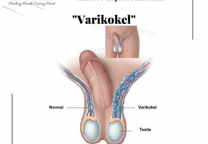 varikokel