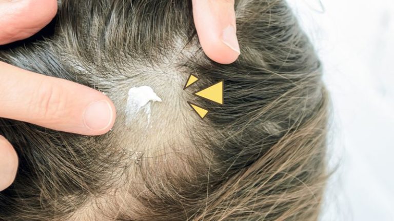 cara menghilangkan jamur pada kepala