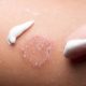 tinea corporis