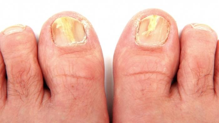 penyebab jamur kuku