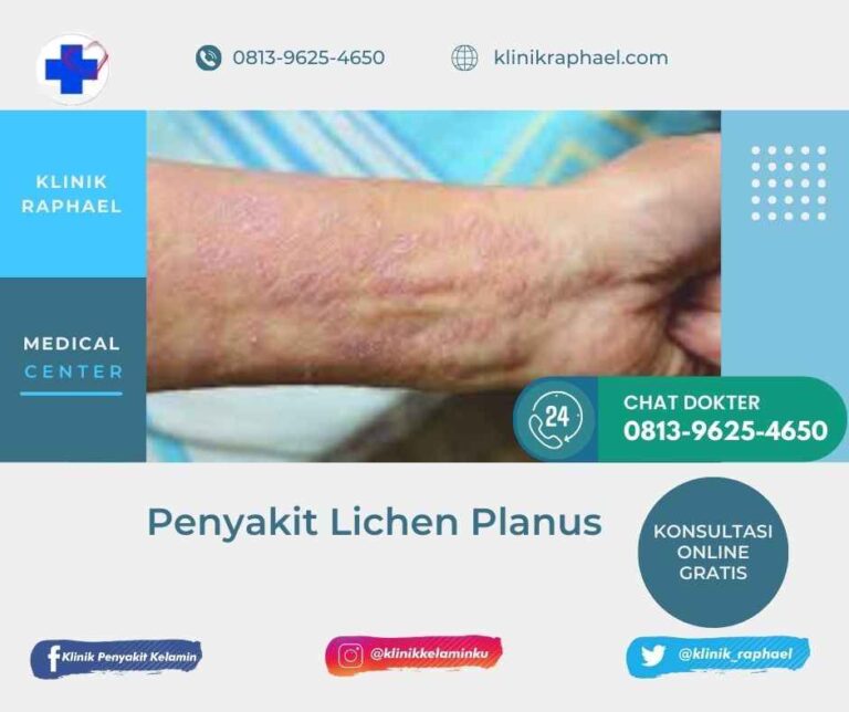 penyakit kulit lichen planus