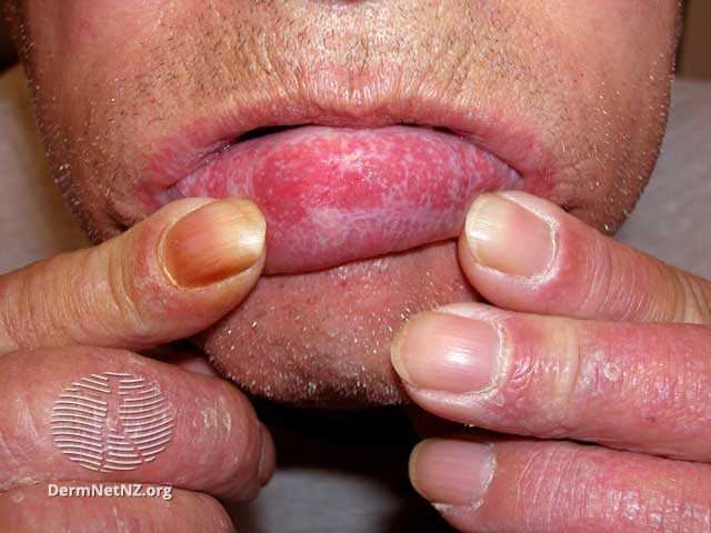 lichen planus di bibir bagian dalam