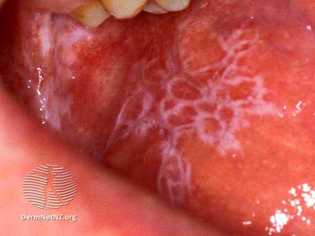 lichen planus di mulut bagian dalam