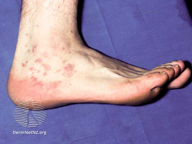 lichen planus di kulit pergelangan kaki