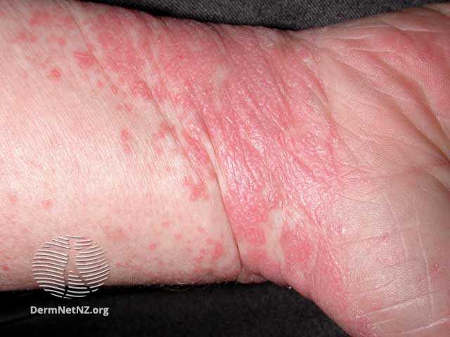 lichen planus pada kulit di pergelangan tangan