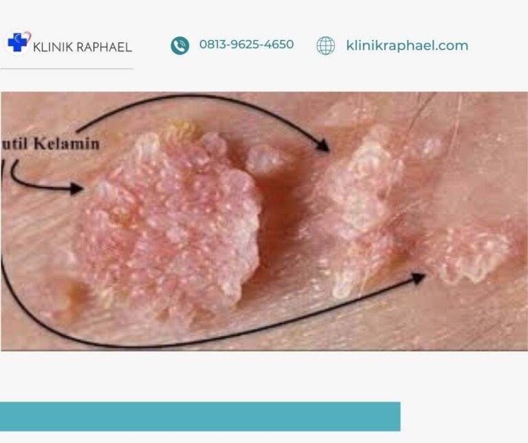 kutil kelamin pada pria dan wanita