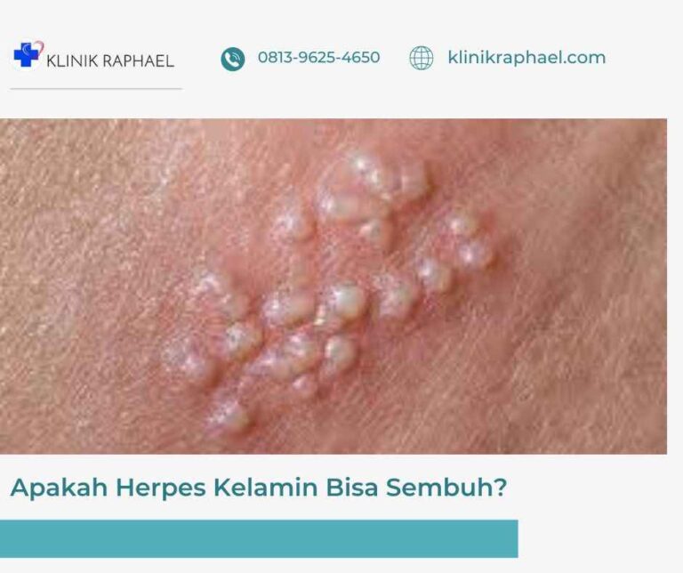 apakah herpes kelamin bisa sembuh