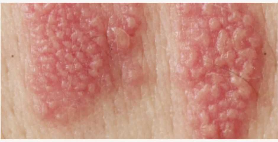 ciri herpes kelamin pada pria dan wanita