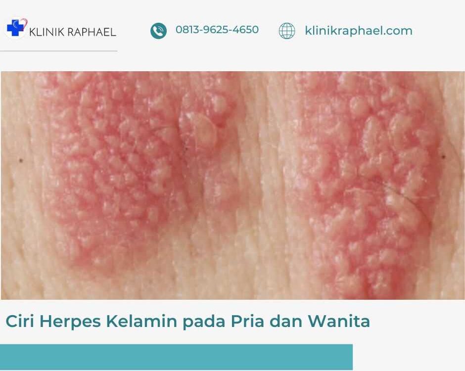ciri herpes kelamin pada pria dan wanita