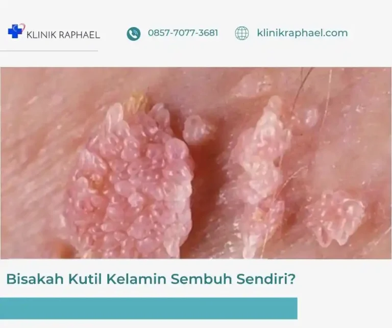 apa kutil kelamin bisa sembuh sendiri