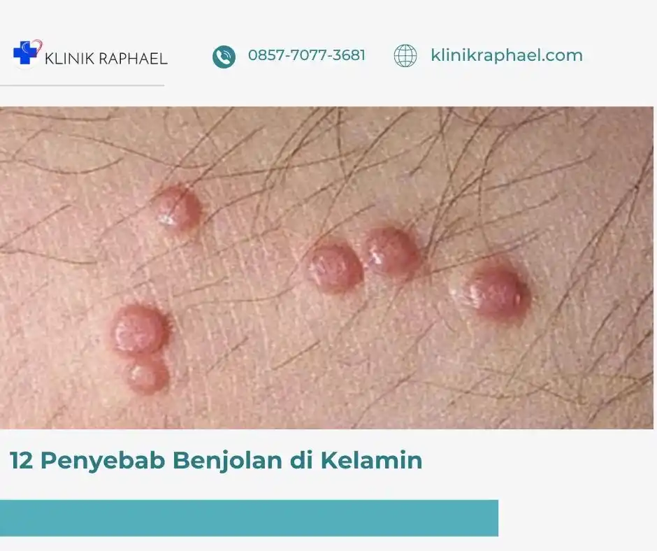 penyebab-benjolan-di-kelamin